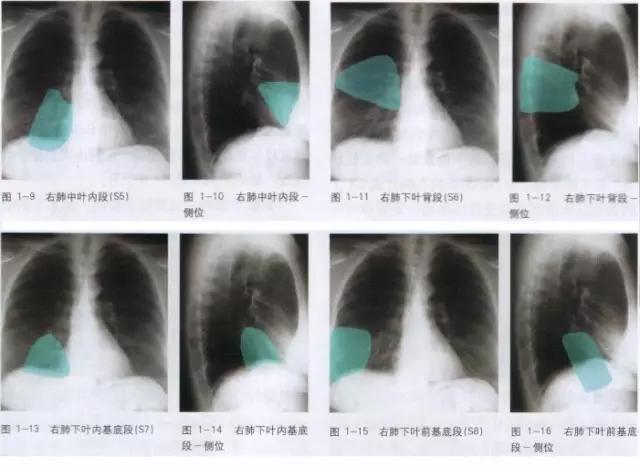 x线影像解剖大全,胸部x线怎么看懂图解