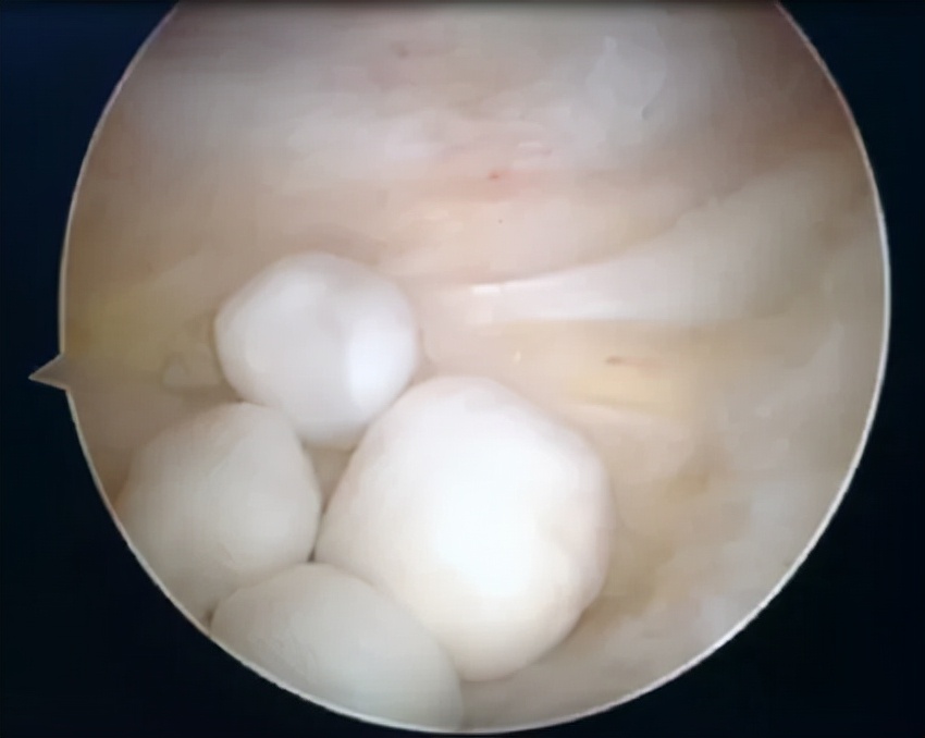 微创手术能治好骨性关节炎吗,膝盖关节镜微创手术要脱衣服吗