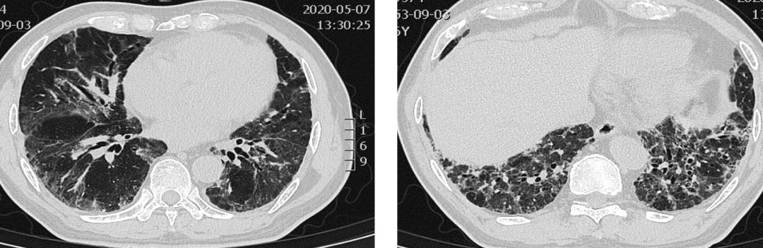 抗合成酶综合征是肺纤维化吗,抗合成酶综合征体征