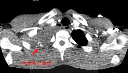 打个喷嚏结果鼻血流出来,打个喷嚏吐出一口血怎么回事