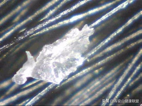 被顽固头屑缠上的四大理由，最后一个你绝对想不到