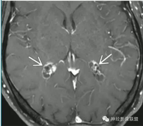 各种囊肿的症状,颅内囊肿18-19mm严重吗