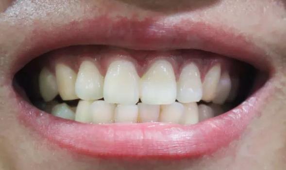 牙齿很敏感，喝凉水又酸又痛？教你远离疼痛困扰