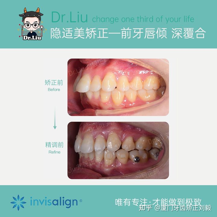 厦门透明牙齿矫正器矫正时间,厦门成人隐形牙齿矫正价格