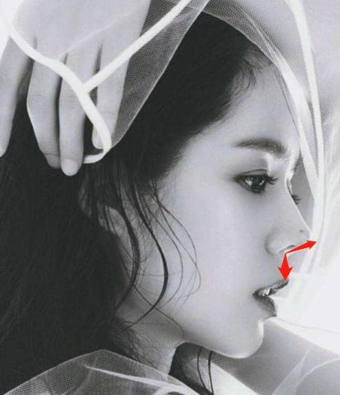 膨体隆鼻跟鼻综合的区别,隆鼻鼻综合做法