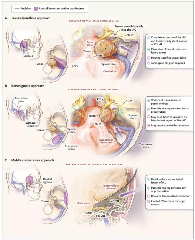 听神经瘤突聋能恢复吗,听神经瘤耳聋了怎么办