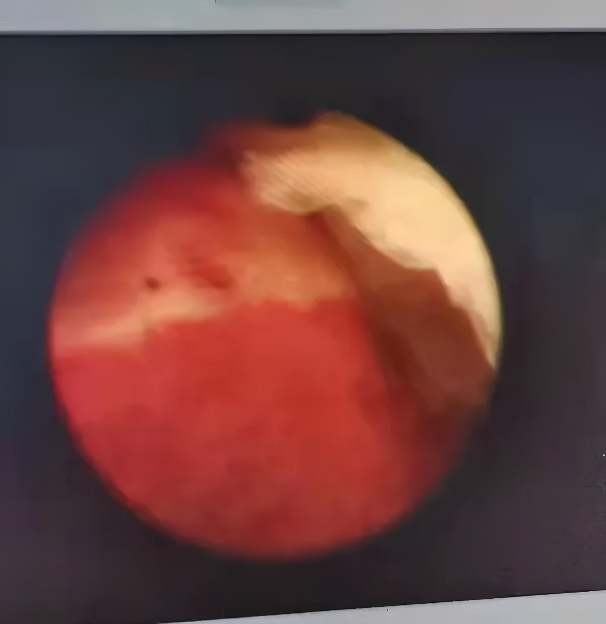 57岁绝经2年又来例假,54岁绝经三年了突然身上来例假了