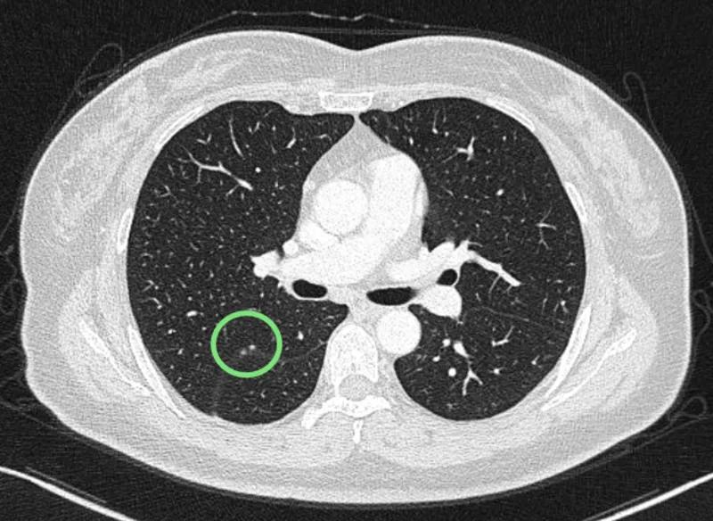 右肺下叶微小结节是什么意思,诊断报告左肺下微小结节没写大小