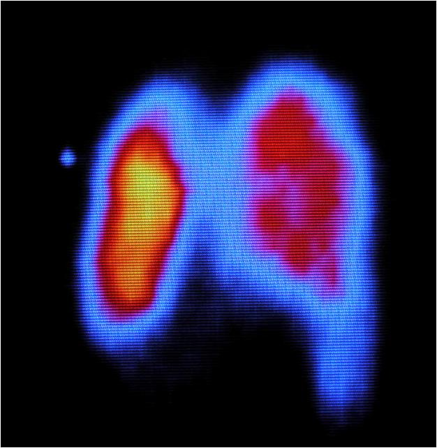 急性心肌梗死的做法,内科主治心肌梗死视频