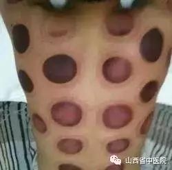 针灸拔罐后注意事项和禁忌症,真空拔罐注意事项可以先用精油吗