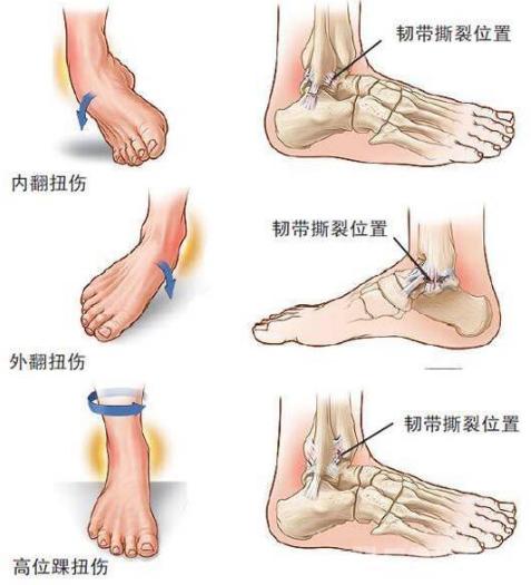 崴脚后快速恢复三个妙招轻松解决,崴脚之后的措施