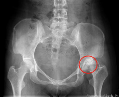 女性髋关节发育不良康复训练,35岁先天性髋关节发育不良修复术