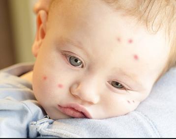 日本婴儿驱蚊产品哪个好,日本驱蚊止痒婴儿专用