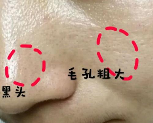 毛孔粗大像橘皮一样怎么办,毛孔粗大人显老