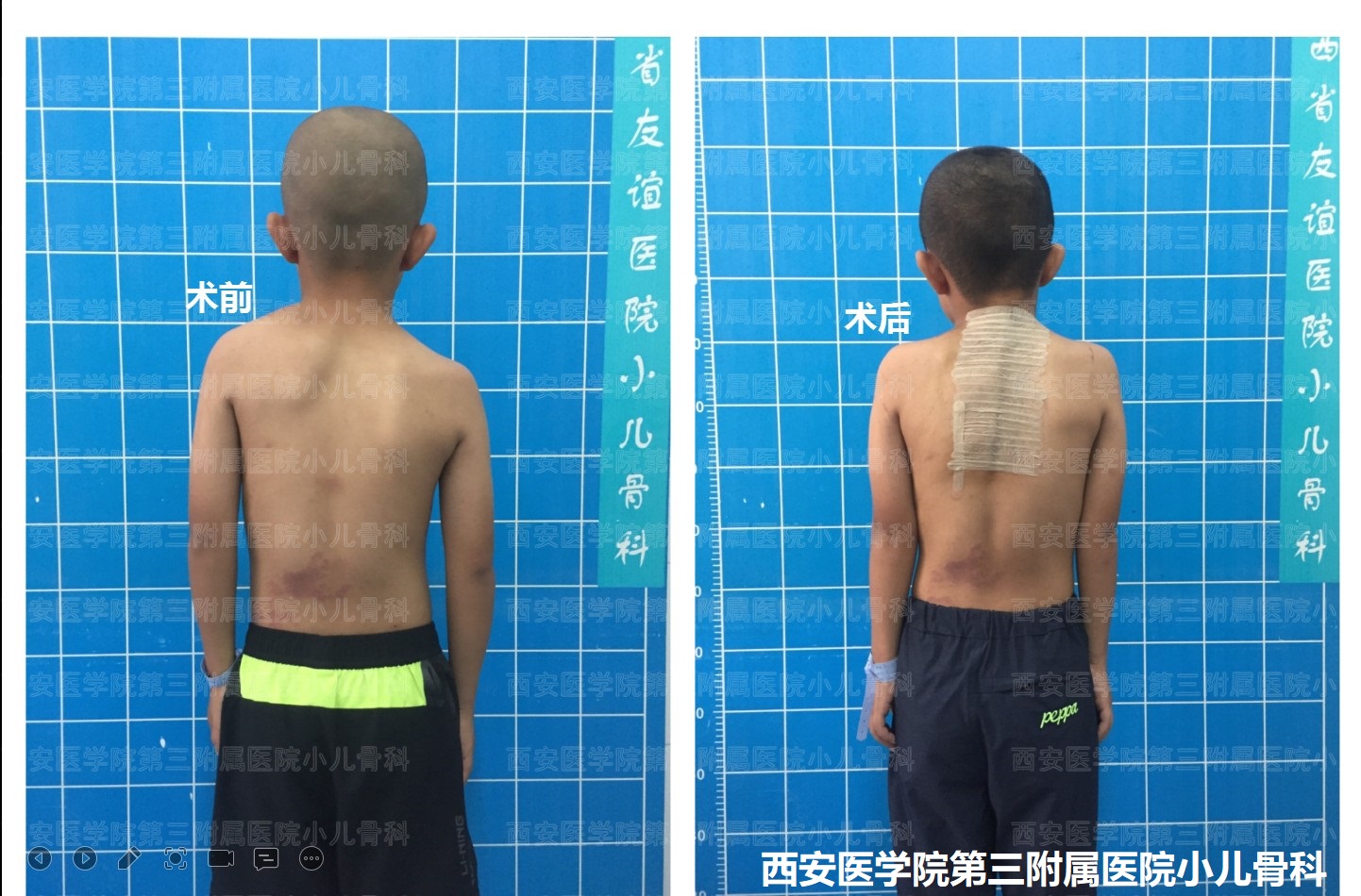 先天性高肩胛手术,先天性肩胛症通过手术需要多少钱