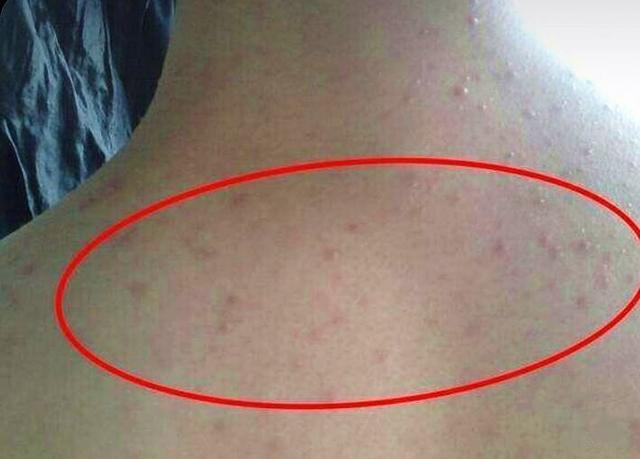 螨虫真的很可怕吗,螨虫有那么严重吗