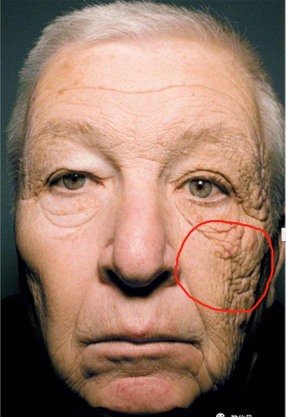 毛孔粗大有黑头怎么办生活妙招,男人毛孔粗大有黑头用什么护肤