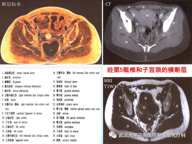女性盆腔解剖与断层影像
