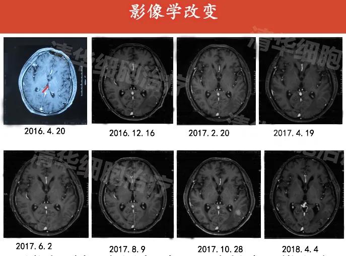 肺癌晚期活不了多久的症状,肺癌晚期生命只剩下六个月