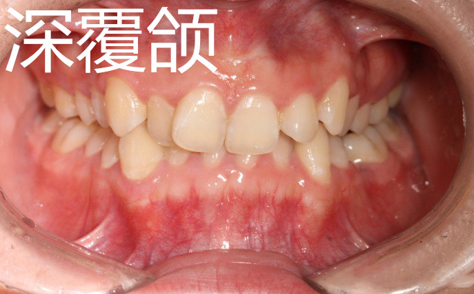 30岁了还可以做牙齿矫正吗,30岁还可以做牙齿矫正吗