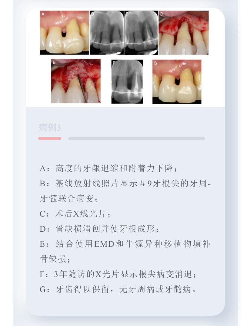牙周病引起的牙髓病变的治疗原则,牙周组织可以修复再生吗