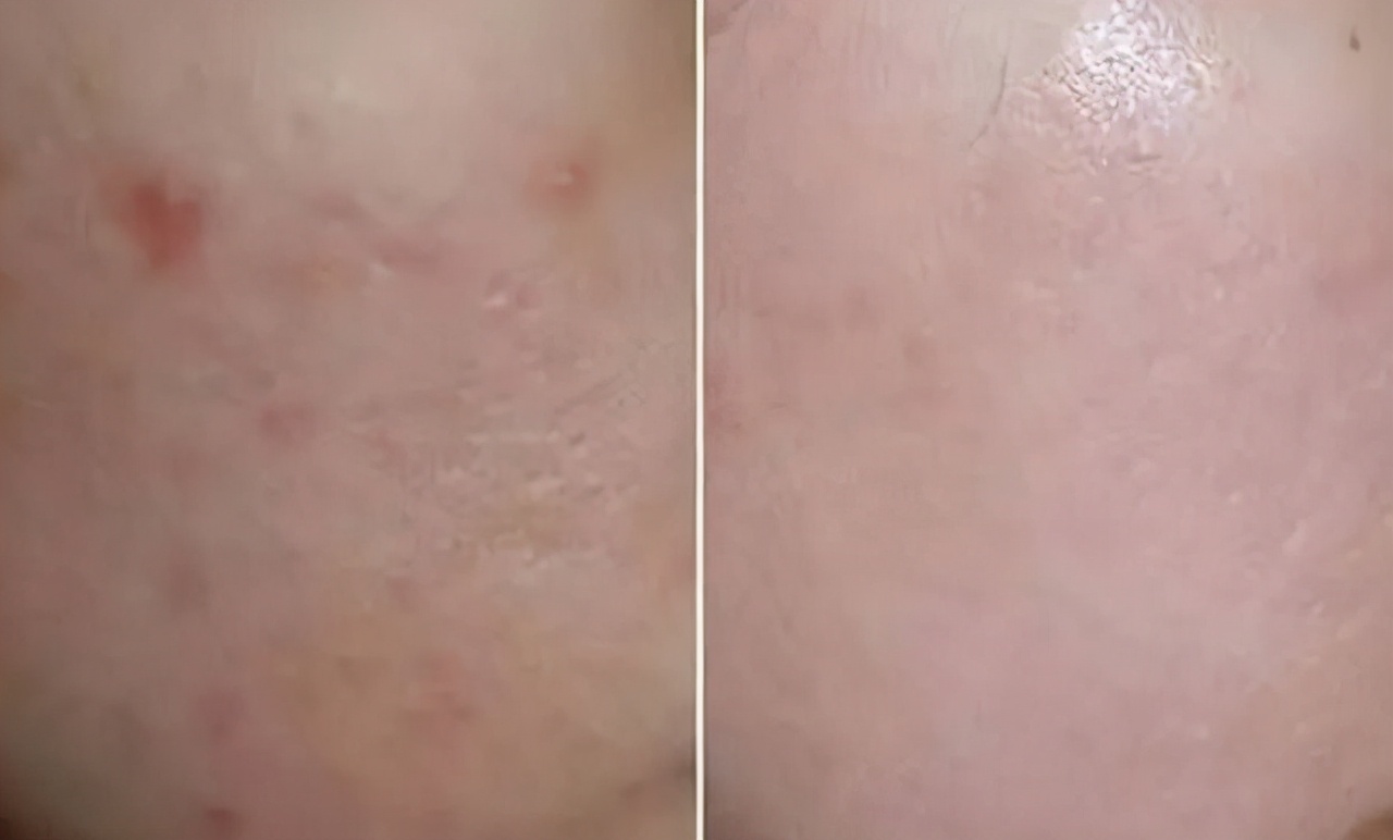 痘印表面好了里面没好,痘印发黑一直下不去用什么好