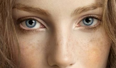 雀斑净能祛除雀斑吗,氢醌乳膏是淡化雀斑还是祛除雀斑