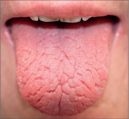 干燥综合征是什么样的症状,干燥综合征是什么样的