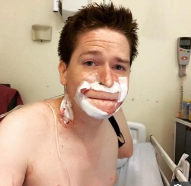 英国男子被狗咬了截肢,男子被动物咬脚趾截肢