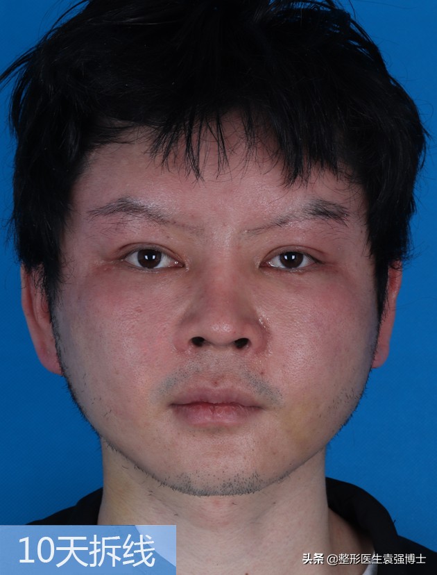 30岁小拉皮手术后7天照片,30岁拉皮恢复过程图片