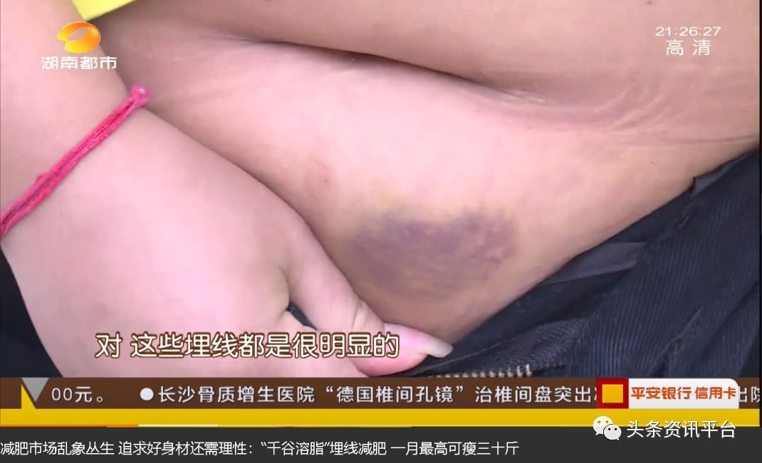 千谷德国溶脂线减肥功效是什么,千谷生物科技