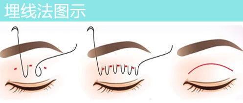 对割双眼皮的看法,你对近视的误解