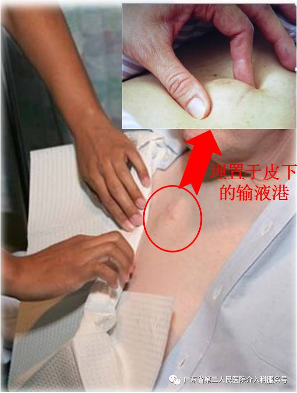 输液港能多次做吗,输液港可以重复使用吗
