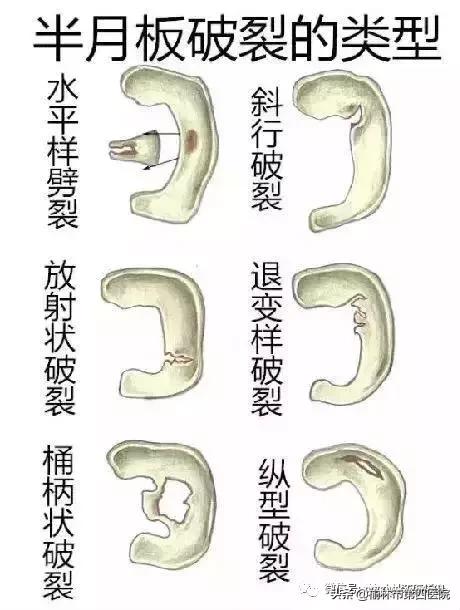 内侧半月板后角损伤怎么治疗,prp治疗半月板损伤有用吗