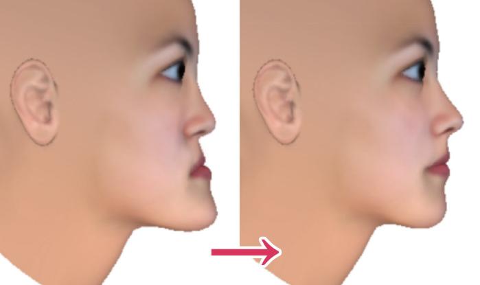 骨性地包天不做正颌手术最好方法,骨性地包天不做手术可矫正吗
