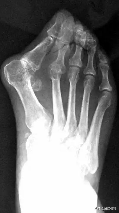 詹姆斯的脚趾发肿,詹姆斯的脚趾是拇外翻吗