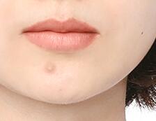 脸上老是长闭口粉刺痒痒的怎么办,10岁女孩脸上长小粉刺怎么回事