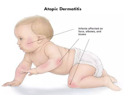 普及！宝宝湿疹不敢用药怕激素？湿疹护理指南来帮你