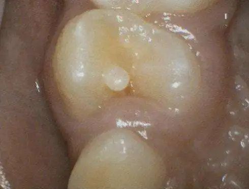 男童牙齿长在牙龈上,男童牙齿内壁长了一颗牙