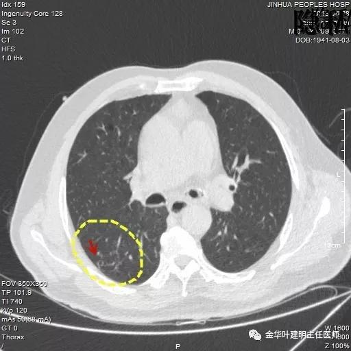警惕-会是简单的肺大泡吗？