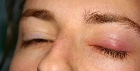 经常熬夜玩手机眼睛会变小吗,每天熬夜玩手机眼睛发黄