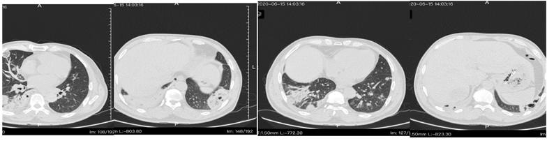 主任医师查房：这个“肺空洞”不简单