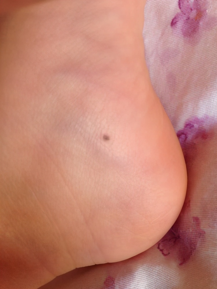 宝宝背后有痣代表什么,宝宝身上的痣会随着身体长吗