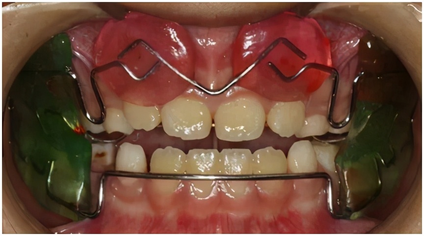 孩子嘴巴地包天有什么说法吗,小孩嘴地包天