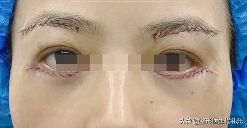 微创祛眼袋和手术开刀哪种效果好,祛眼袋手术术后眼睛青紫怎么办