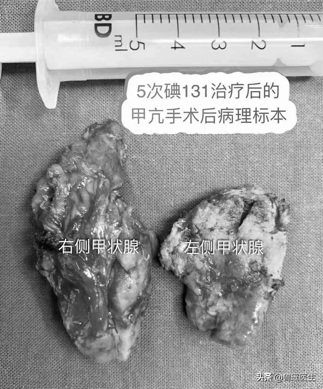 甲亢用过碘131还会复发吗,甲亢用碘131治疗好的患者案例