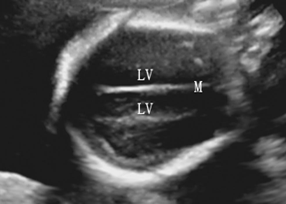 孕期头部彩超查什么,孕期检查胎儿头部有一个地方宽