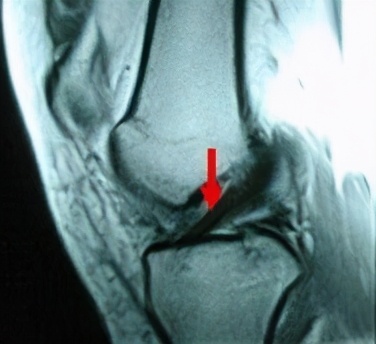 前交叉韧带损伤核磁共振,前后交叉韧带损伤的治疗