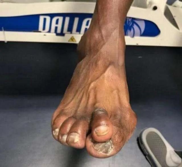 詹姆斯的脚有多可怕,詹姆斯脚踝有多厉害