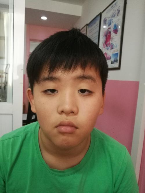 儿童上睑下垂最严重是哪种,儿童上睑下垂需要做很多次吗
